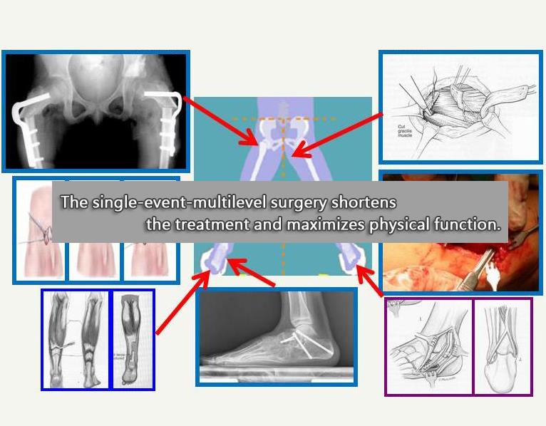 The single-event-multilevel surgery shortens the treatment and maximizes physical function.