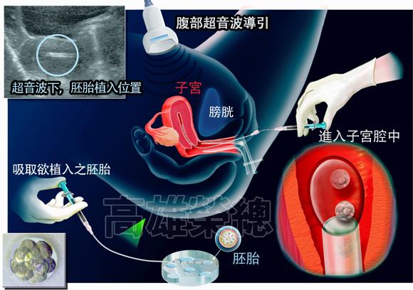胚胎植入
