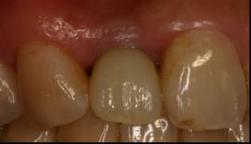 圖九、戴臨時假牙時，牙齦透出金屬暗色