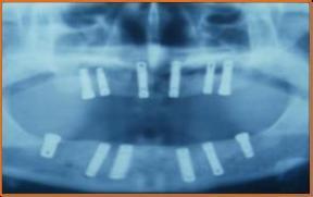 人工牙根植入後全口X光片