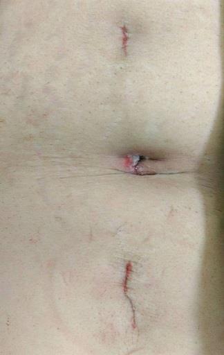 腹腔鏡術後傷口圖